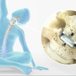 Spinal Disc Replacement